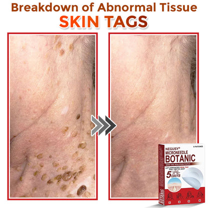 NEGUSY™ Removal Patch: Gentle Microneedle Patches for SkinTag & Mole Removal