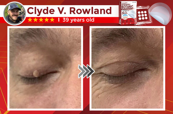 NEGUSY™ Removal Patch: Gentle Microneedle Patches for SkinTag & Mole Removal