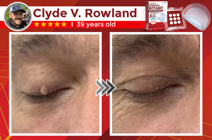 NEGUSY™ Removal Patch: Gentle Microneedle Patches for SkinTag & Mole Removal