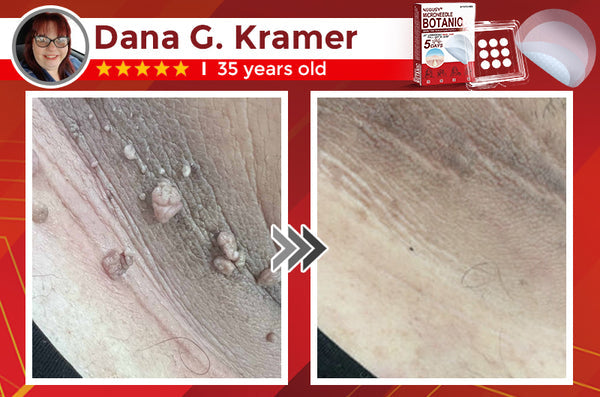 NEGUSY™ Removal Patch: Gentle Microneedle Patches for SkinTag & Mole Removal