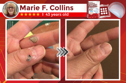 NEGUSY™ Removal Patch: Gentle Microneedle Patches for SkinTag & Mole Removal