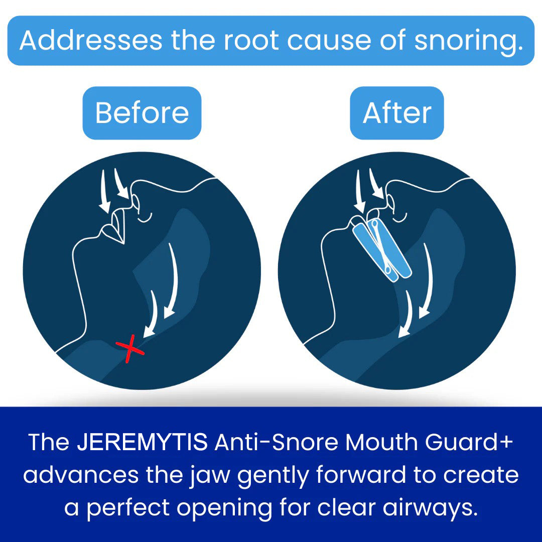 LAST DAY SALE 60% OFF ⏰PerfectSleep Solution-Anti-Snoring & Anti-Grinding Teeth Protector