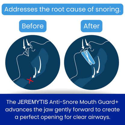 LAST DAY SALE 60% OFF ⏰PerfectSleep Solution-Anti-Snoring & Anti-Grinding Teeth Protector