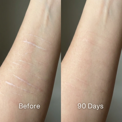 ODALIT™ Silicon ScarStick Limited Time 75%OFF Buy 1 Get 2 Free🔥LAST DAY⏰