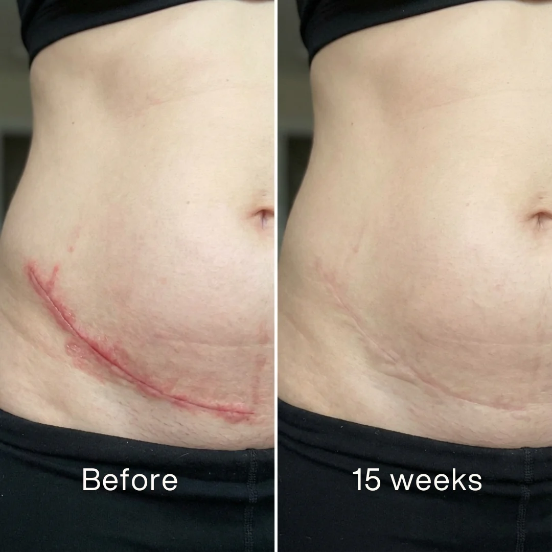 ODALIT™ Silicon ScarStick Limited Time 75%OFF Buy 1 Get 2 Free🔥LAST DAY⏰