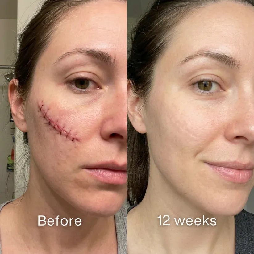 ODALIT™ Silicon ScarStick Limited Time 75%OFF Buy 1 Get 2 Free🔥LAST DAY⏰