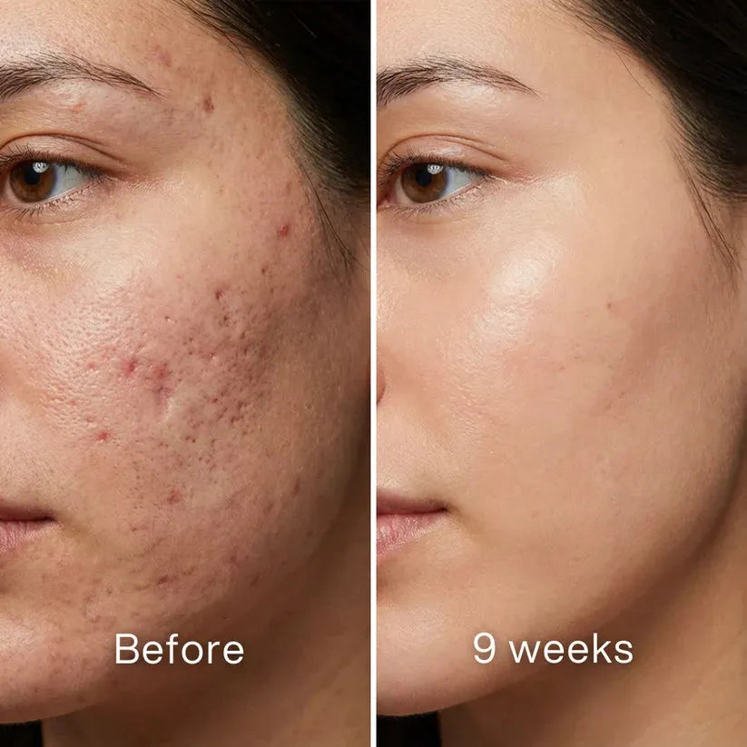 ODALIT™ Silicon ScarStick Limited Time 75%OFF Buy 1 Get 2 Free🔥LAST DAY⏰